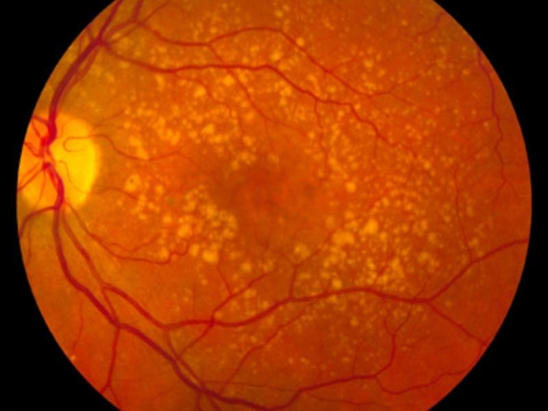 Degeneração Macular